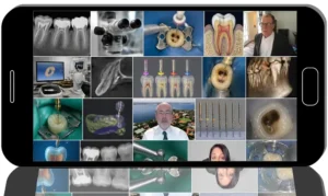 Endo Excellence: From Anesthesia to Obturation