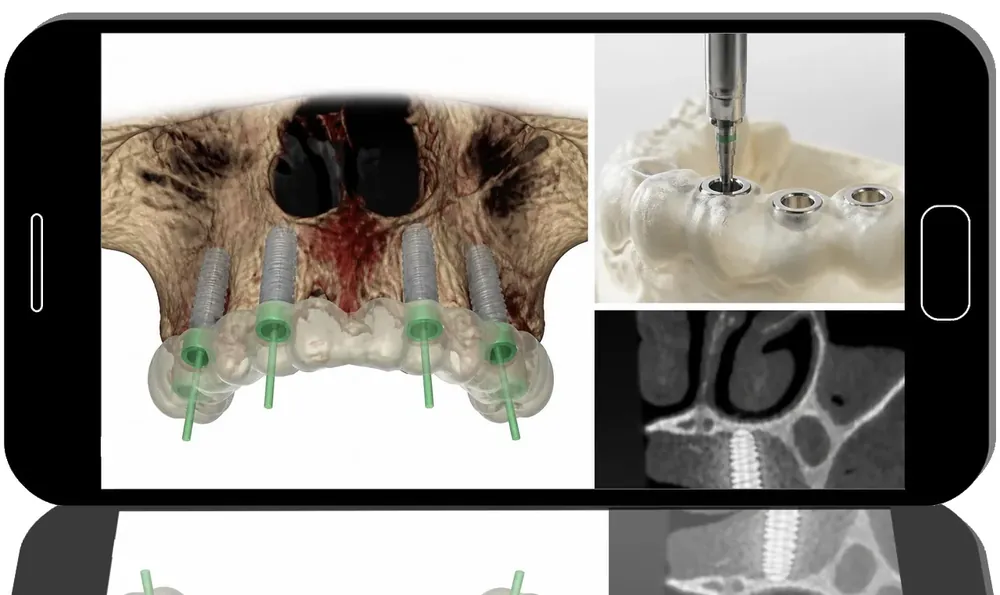 Navigation Implantology Expert Guide