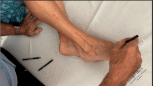 Lyftogt Perineural Injection Treatment: How to Treat Peripheral Nerve Pain 2024