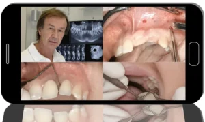 Advanced Bone Regeneration Protocols