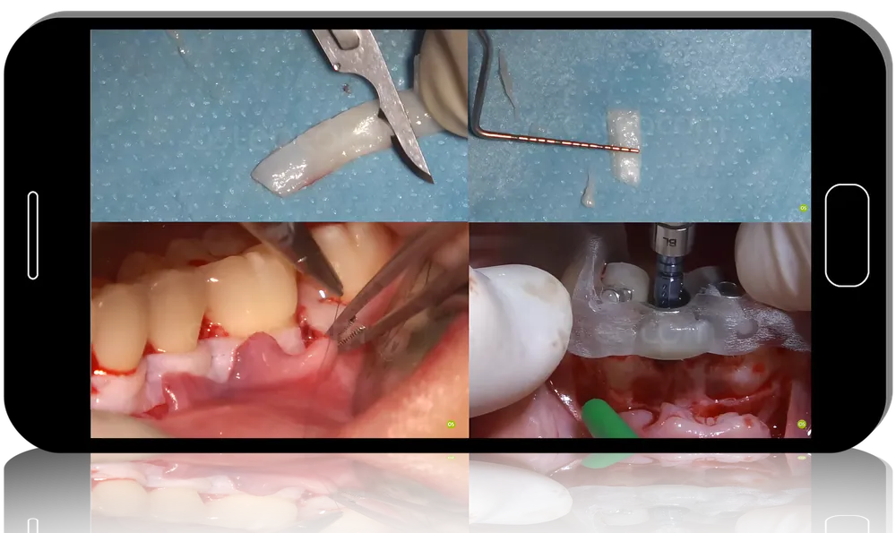 Modern Approaches to Regenerative Periodontal Surgery and Soft Tissue Augmentation - Zucchelli Channel International 2024