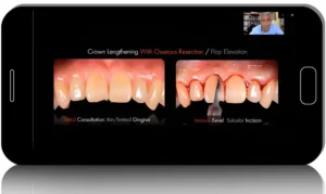 Crown Lengthening From Conventional to Digital Approach