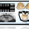 Fast Track Full-Arch Dentistry: Implant Overdentures