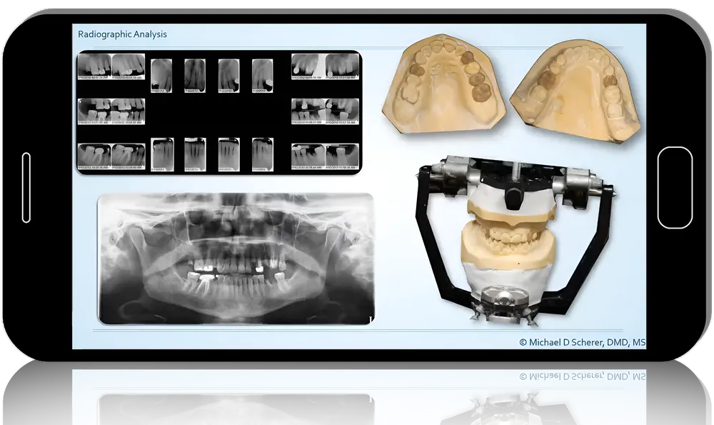 Fast Track Full-Arch Dentistry: Implant Overdentures