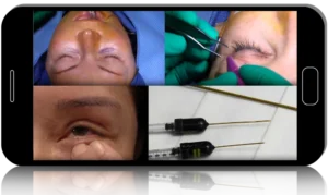 Aesthetic Eyelid and Periorbital Surgery:  Surgical Adjuncts and Pearls for Success