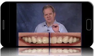 Smile Zone Mastery: Anterior Restorations Made Predictable
