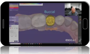 EXOCAD Implant Restorations - Step-by-step Video Guide 2023