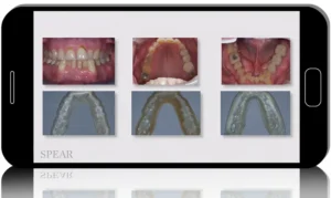 The Seattle Protocol: A Step-by-Step System for Airway Appliance Therapy