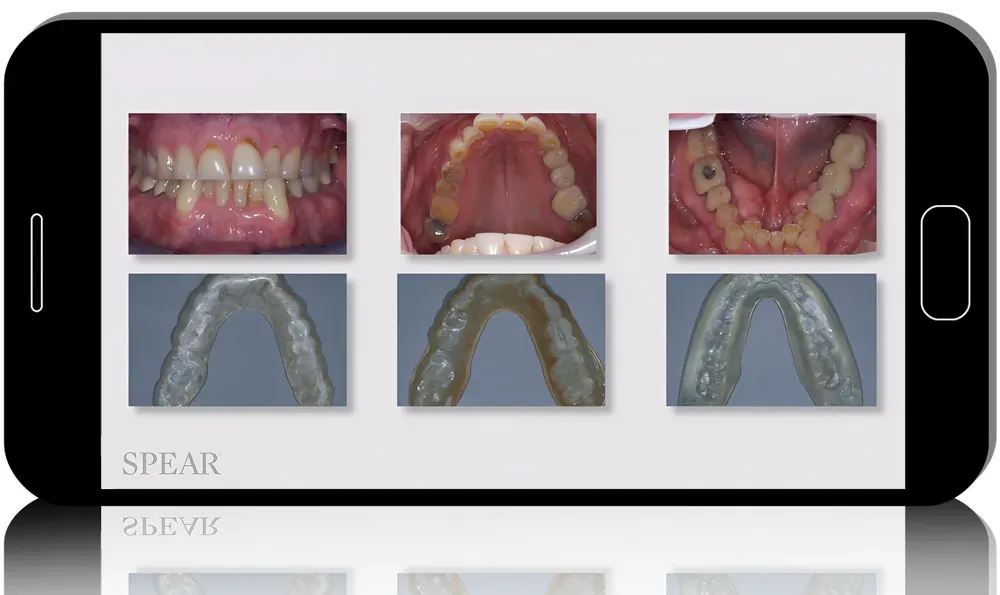 The Seattle Protocol: A Step-by-Step System for Airway Appliance Therapy