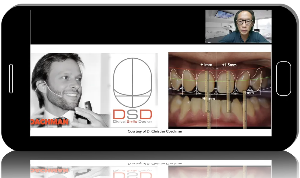 Beautiful Soft Tissue Around Anterior Implants