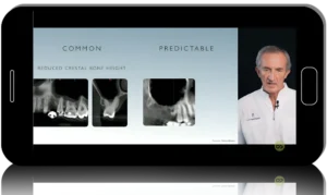 Piezosurgery for Sinus Augmentation: Step-by-Step Clinical Workflow