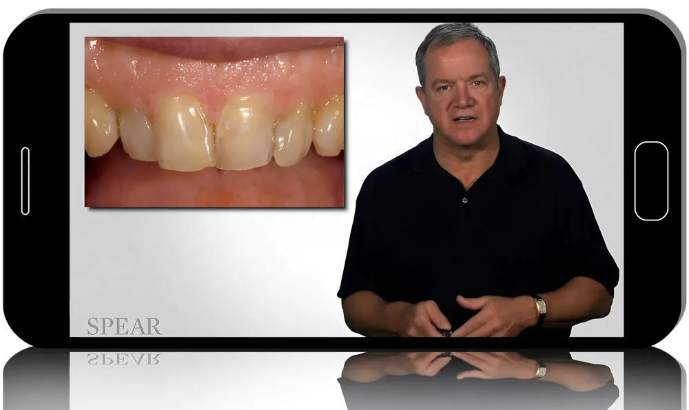 Move Teeth or Restore? Decision-Making for Predictable Alignment