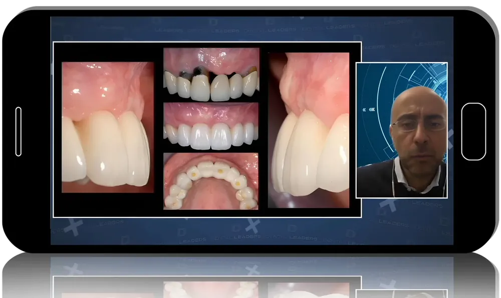 Prosthetic Enhancement of Surgically Augmented Soft Tissue around Dental Implants