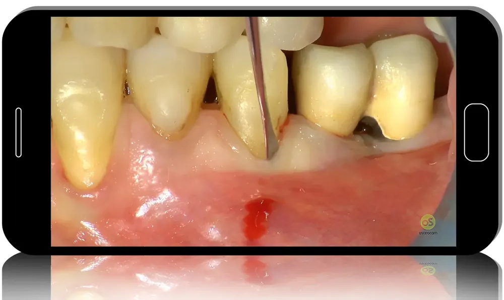 Modern Periodontal Care: Tissue-Preserving, Minimally Invasive Solutions
