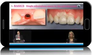 ITI International Team for Implantology Webinar & Video Lectures Package Part-2