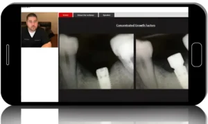 Concentrated Growth Factors CGF/PRF within Dentistry