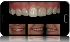Surgical Master: Esthetic and Functional Crown Lengthening