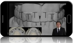 gIDE - Edentulous Patient Implant Placement and Restoration