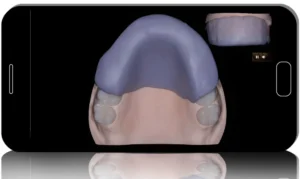 Mastering Prosthodontics: From Impressions to Edentulous Solutions