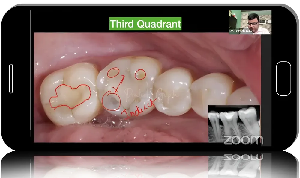 Mastering Tooth Structure: The 4C Concept, Contacts & Contours