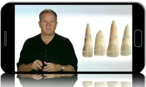 Smile Design Simplified: Implants, Provisionals & Perfect Shade Matching