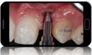 GBR (Guided Bone Regeneration) Surgery Channel