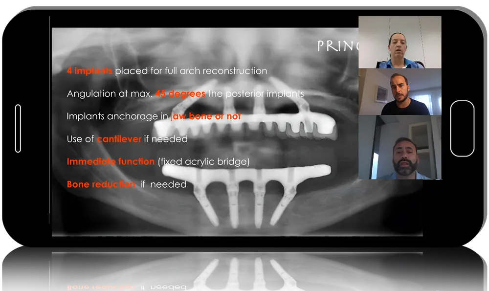 All-On-4 Implant Prosthesis