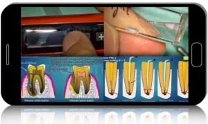 EndoArt: The Science and Craft of Orthograde Retreatment