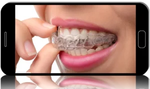 A one year program on aligner therapy