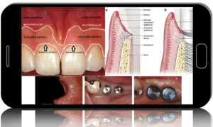 Soft Tissue Management for Implants, The Complete Course