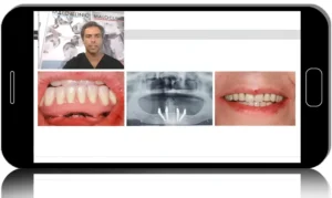 Surgical Aspects of the MALO CLINIC Protocol From Standard to Zygoma Cases