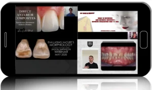 Restorations: Layering Technique and Anatomy