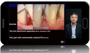 The Single Flap Approach: Regenerative Procedure Selection