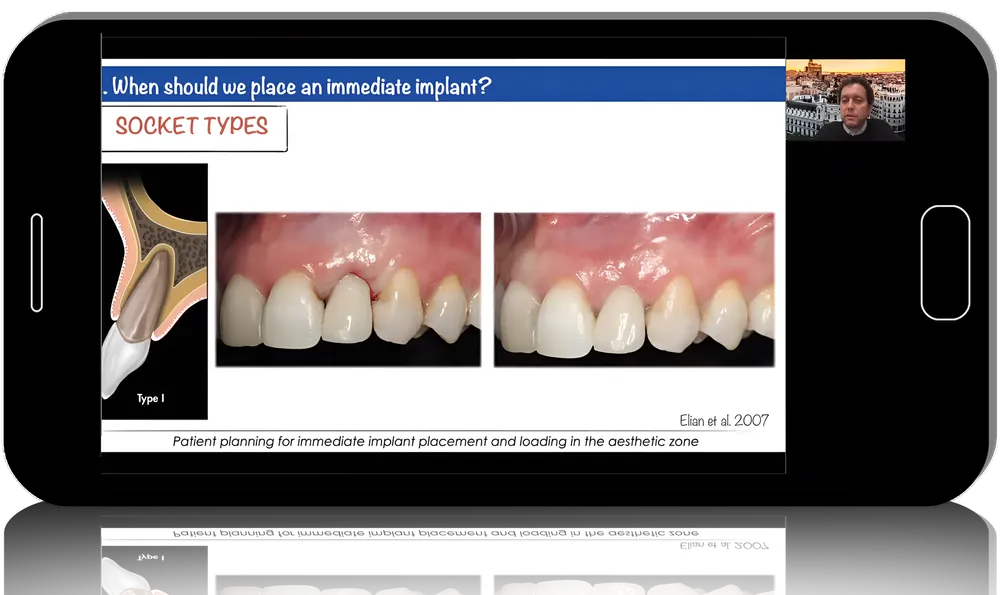 Immediate Implant Placement and Loading: Surgical Protocols